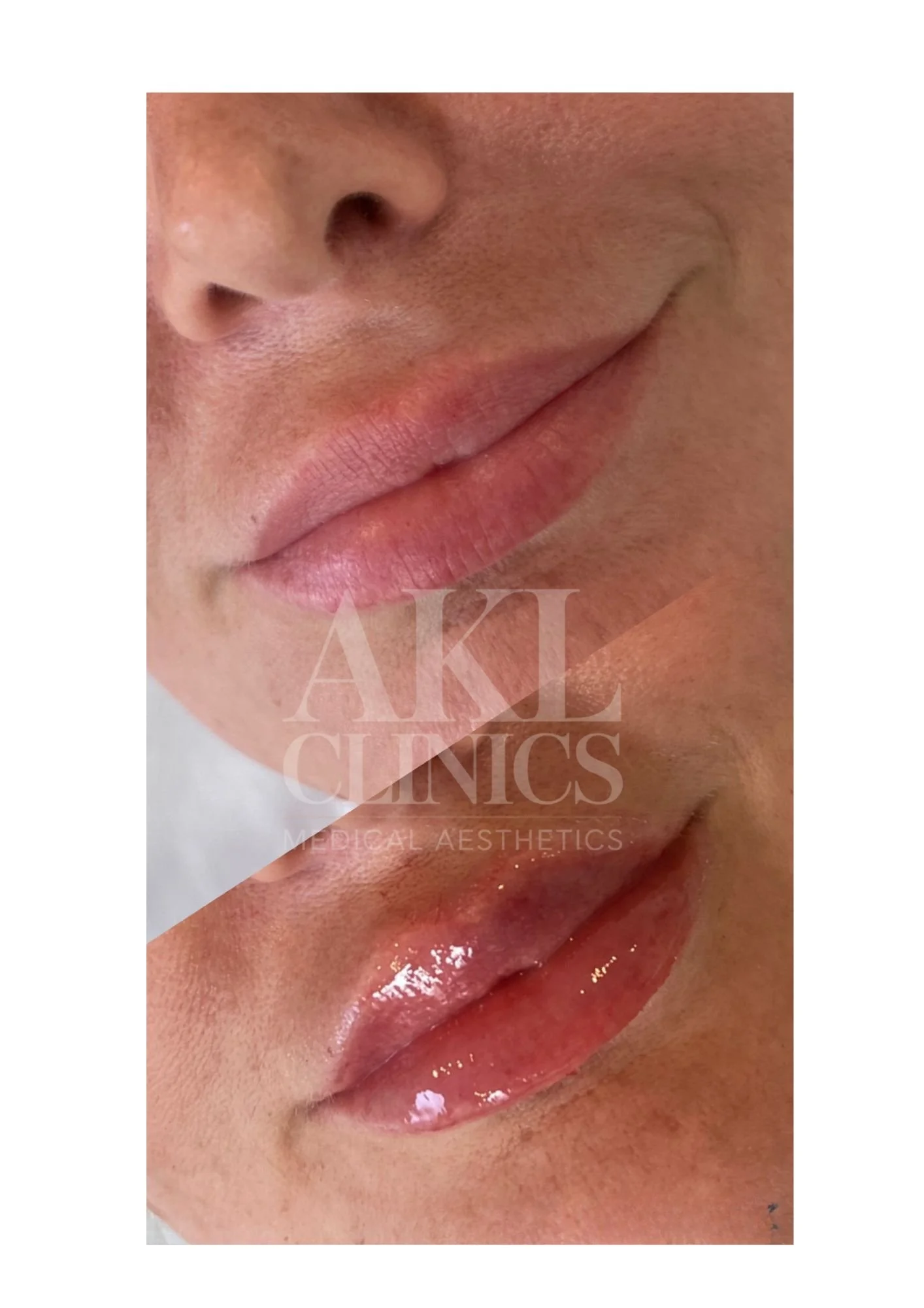 Close-up of a person's lips before and after lip enhancement procedure.