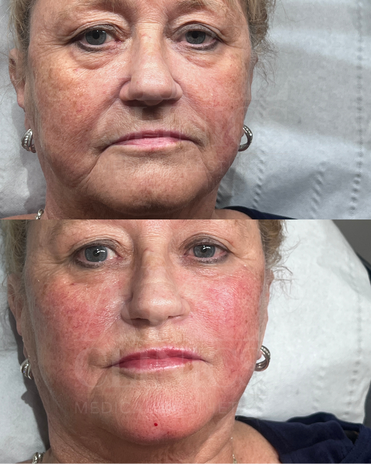 Dermal filler - profile balancing
