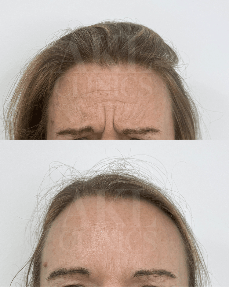 Anti-wrinkle results - crow's feet and brow