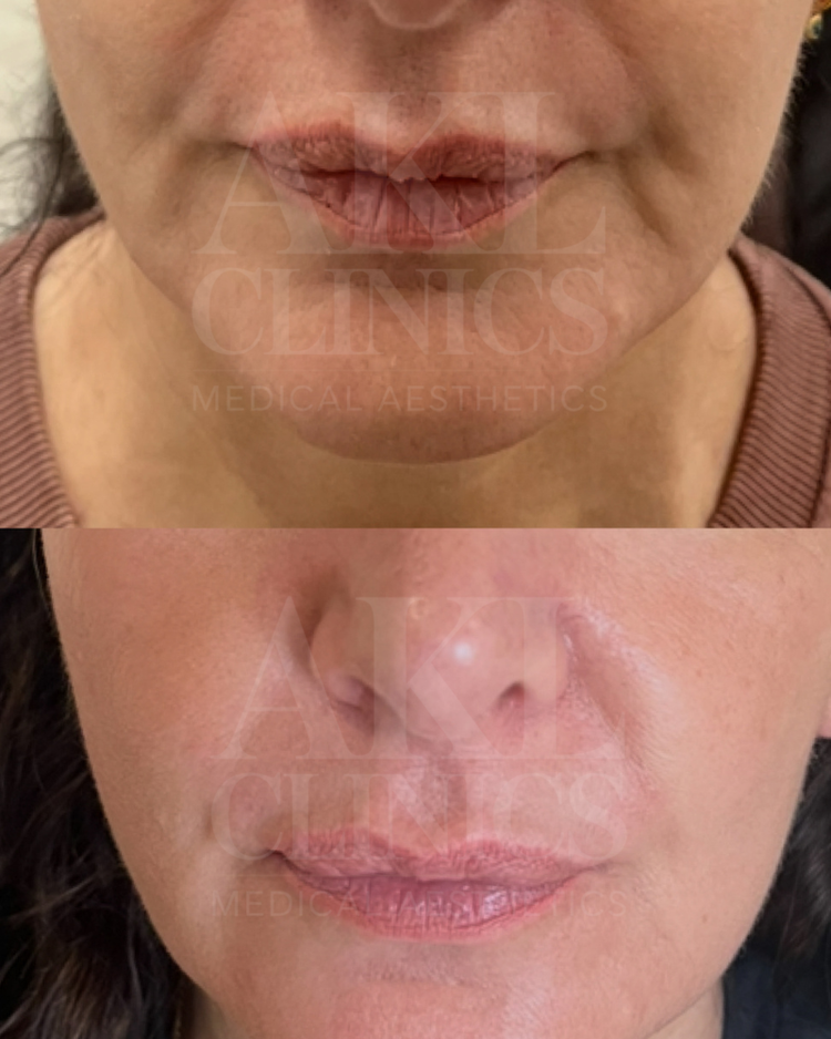 Skin boosters - hydration and radiance
