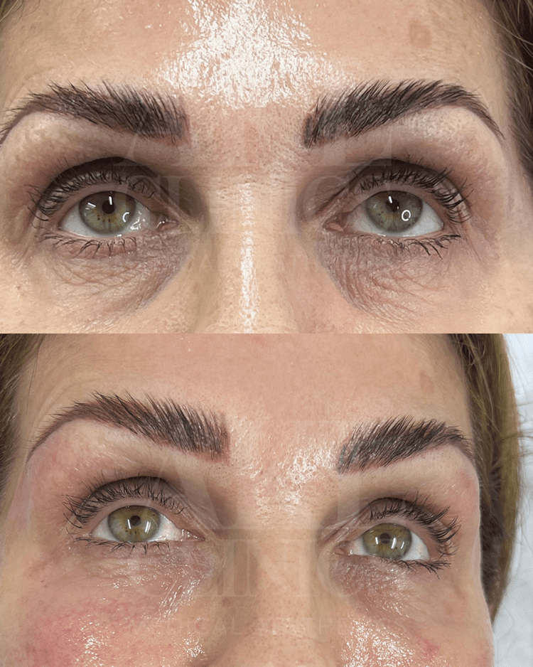 Polynucleotides - under eye rejuvenation