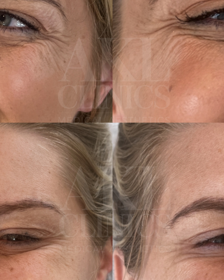 Anti-wrinkle results - full upper face