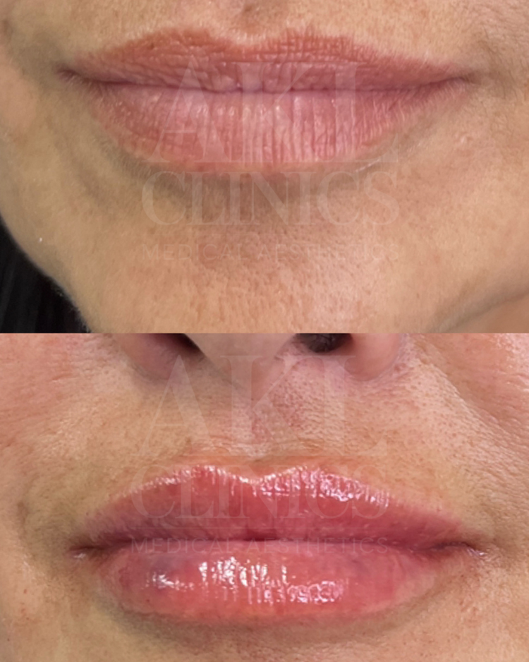 Lip filler results - natural enhancement