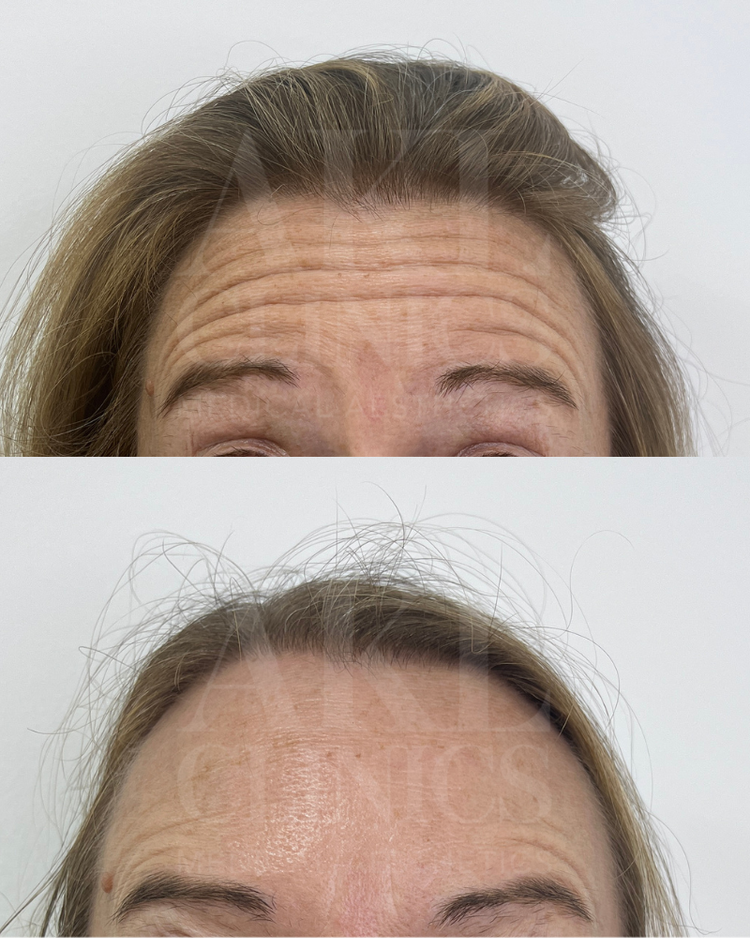 Anti-wrinkle results - forehead and frown lines