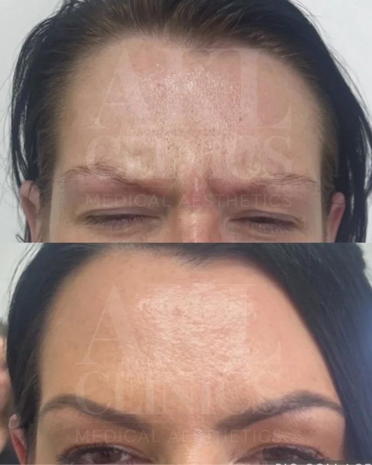 Anti-wrinkle results - forehead lines