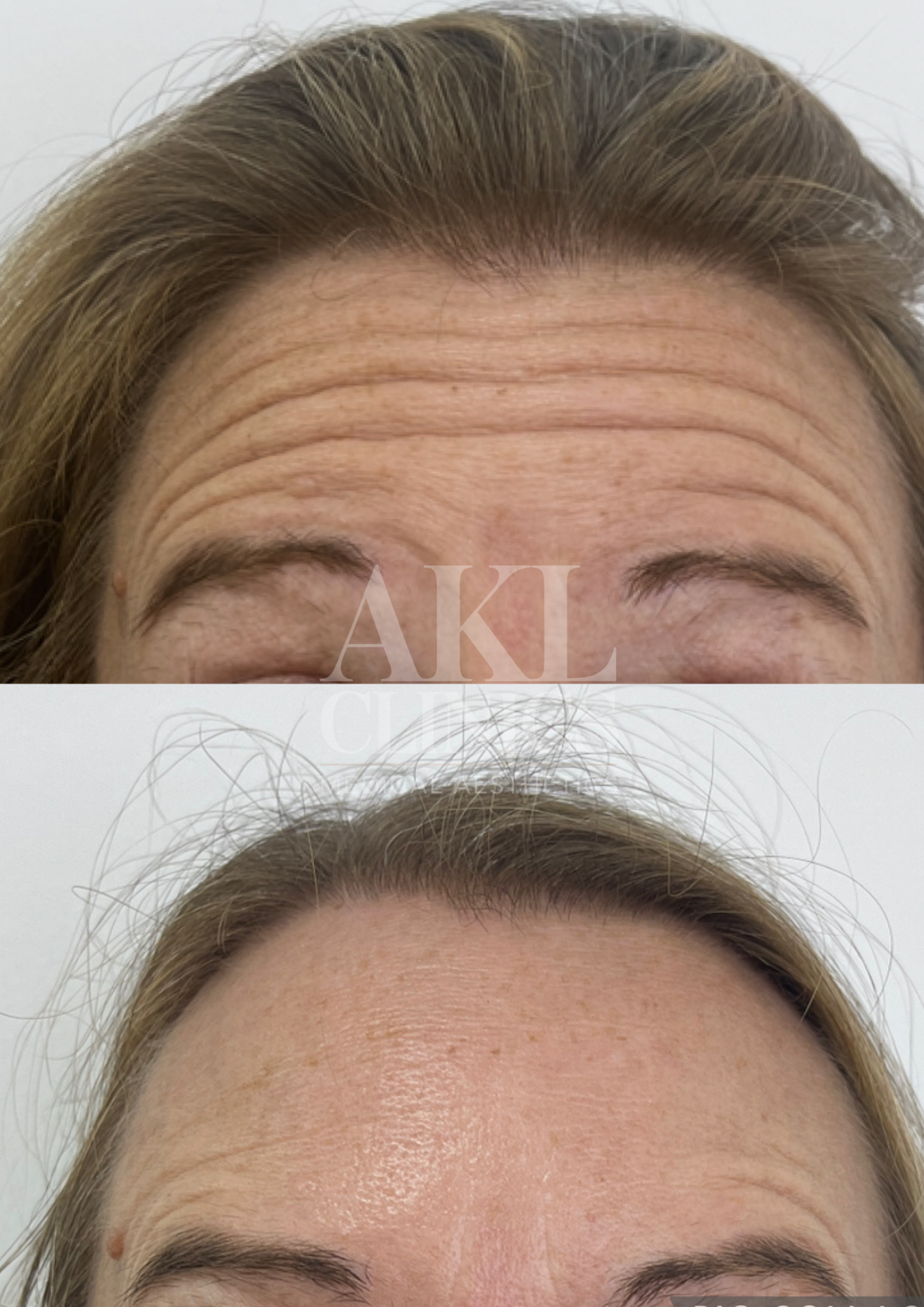 Before and after images of a woman's forehead, showing reduced wrinkles after cosmetic treatment, with the logo 'Simple Choices.'
