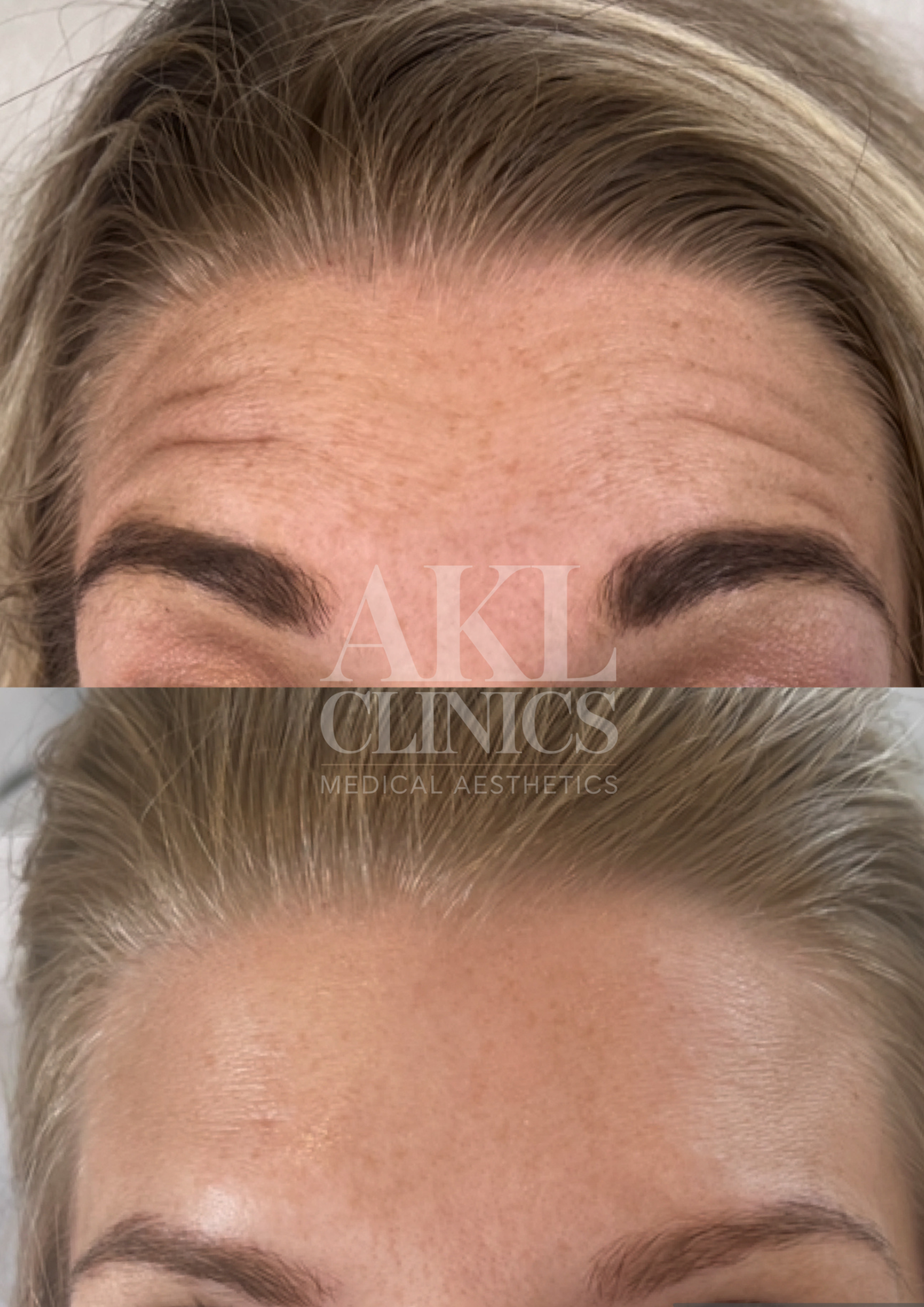 Before and after images of a woman's forehead showing the reduction of wrinkles after a cosmetic treatment. The top image shows forehead wrinkles and the bottom image shows smoother skin.