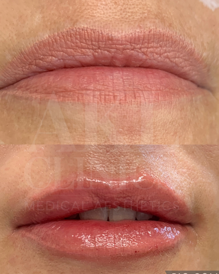 Lip filler before and after