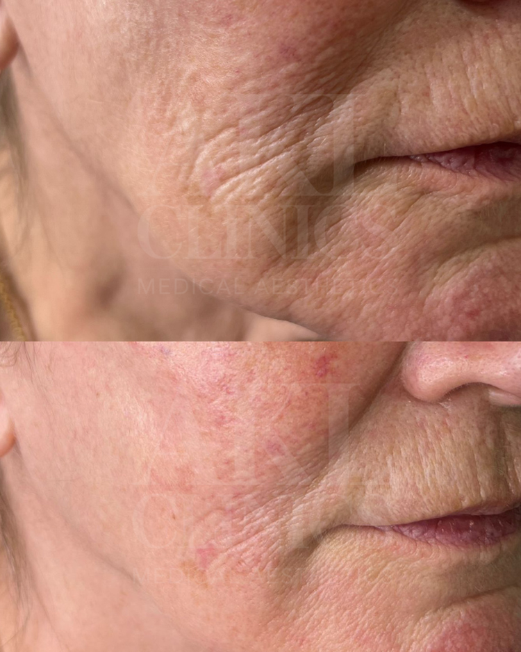 Polynucleotides - skin renewal