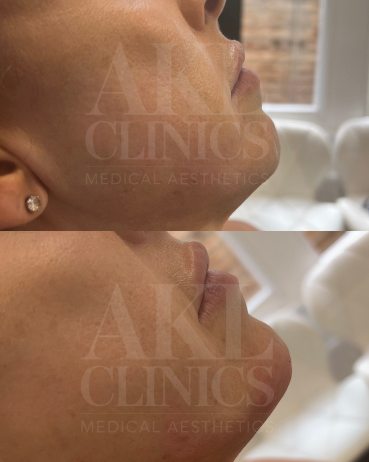 Dermal filler - chin and jaw contouring