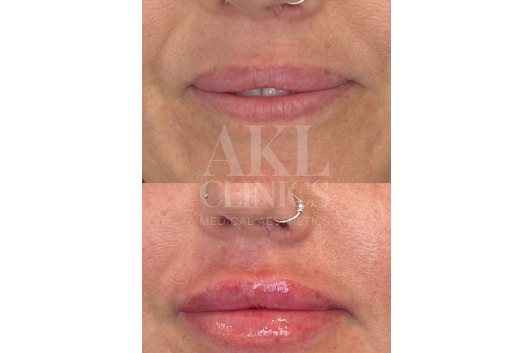 Close-up of a woman's face showing before and after lip cosmetic enhancement, with the lower image displaying fuller, plumper lips.