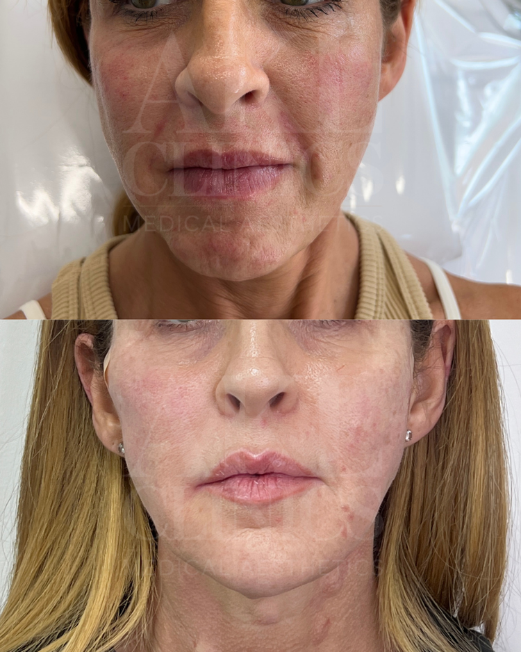 Midface filler - cheek volume restoration