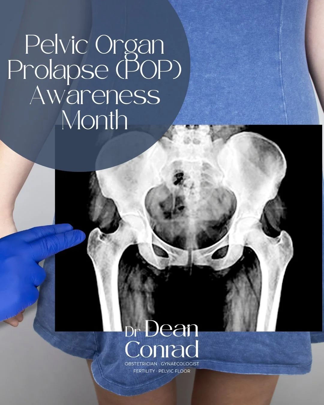 June is Pelvic Organ Prolapse Awareness Month

Pelvic organ prolapse occurs when the tissues and muscles that support the pelvic organs become weakened, allowing the bladder, uterus, bowel, or top of the vagina to drop down and create a bulge or feel
