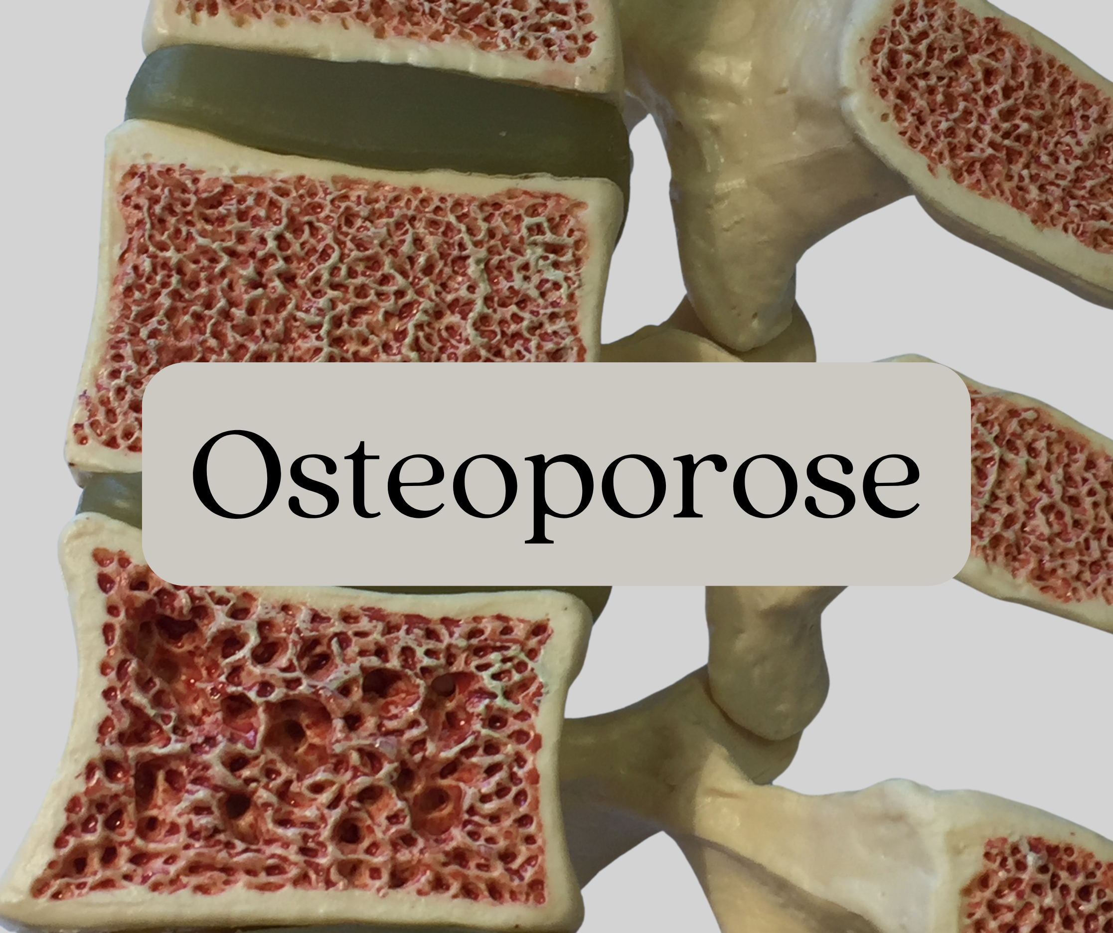 Modell von menschlichen Wirbeln mit Osteoporose-Darstellung, zeigt poröse Knochentextur.