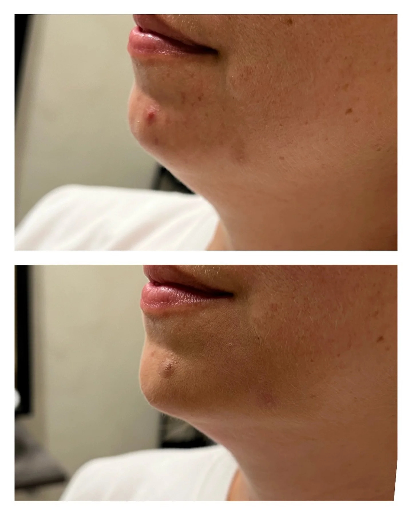 - HAKA -
Denna haka har framhävts med hjälp av 1ml fillers för att skapa balans i profil men även framifrån. 
Varmt välkommen att boka en gratis konsultation!
Länk till bokning finns i profilen.
#fillers #filler