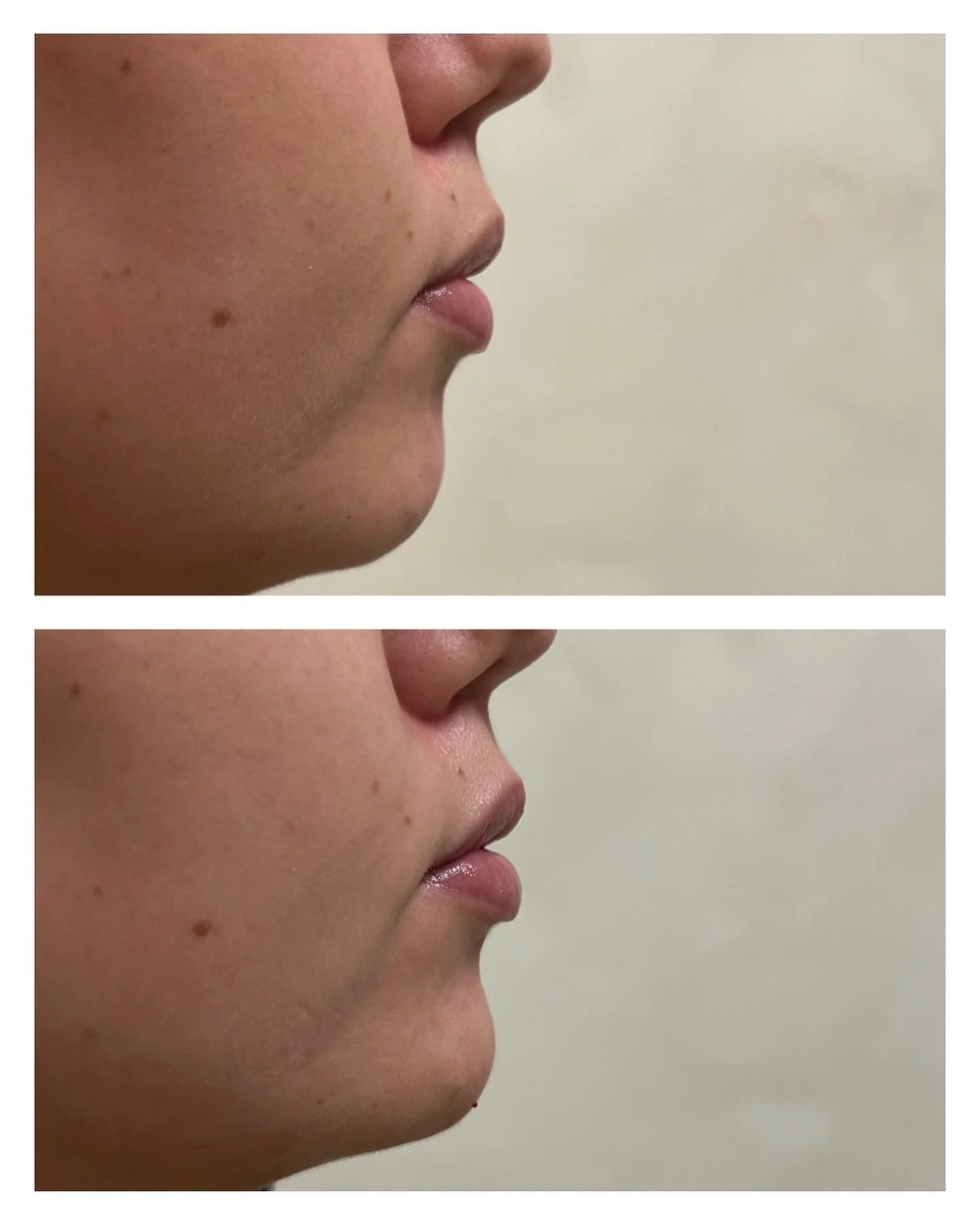 - HAKA -
Här har vi lagt 1ml fillers i hakan för att balansera profilen. Resultatet syns på en gång och kunden upplever oftast inte det som en smärtsam behandling.