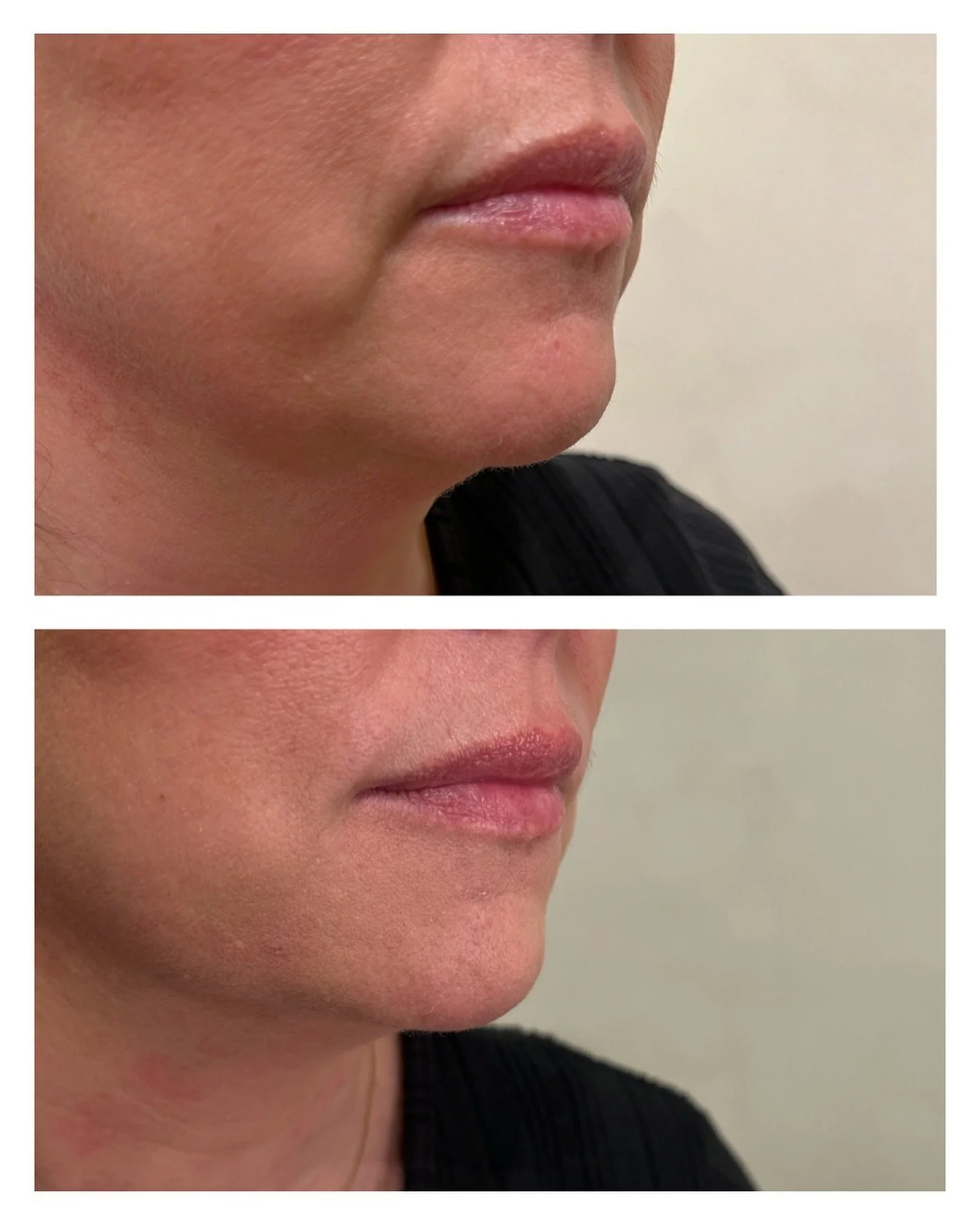 En gladare mun!
På denna kund har vi jobbat med fillers i mungiporna och längst med marionettlinjerna. Behandlingen ger ett snabbt och synligt resultat. Vi använde totalt 1 ml.