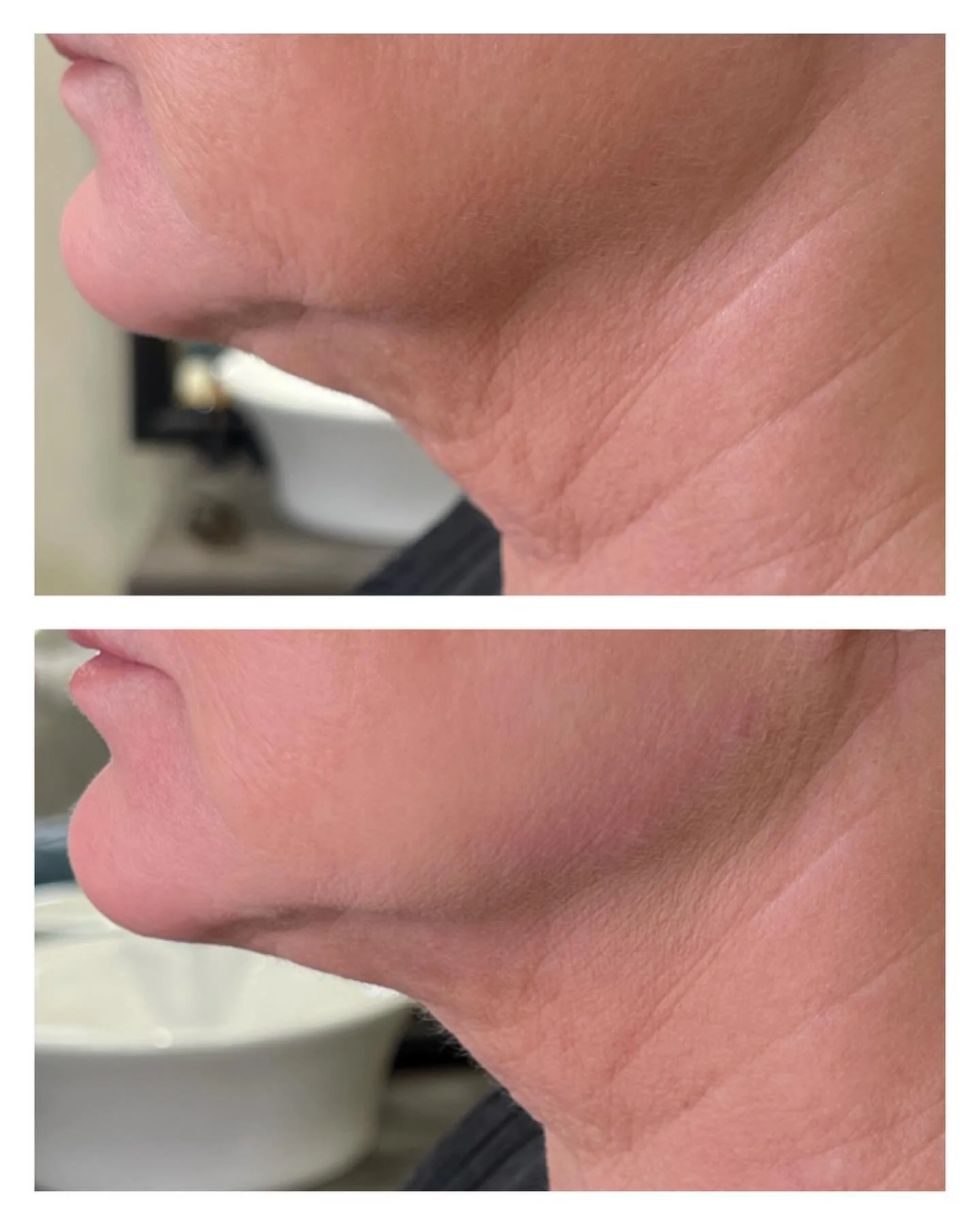 KÄKLINJE 
Här har vi fokuserat på att få en mer definierad käklinje och en uppstramande effekt av nedre delen på ansiktet. Vi använde 1 ml fillers totalt.
#fillers #filler #käklinje #jawline #jawlinefiller