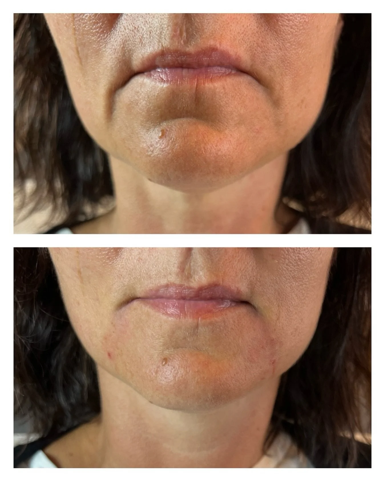 - Marionettlinjer -
Här har vi använt 1 ml fillers för att återskapa ett gladare utseende kring munnen. 
Marionettlinjer sträcker sig nedåt från mungiporna och kan skapa ett bekymrat eller ledsamt utseende. Det