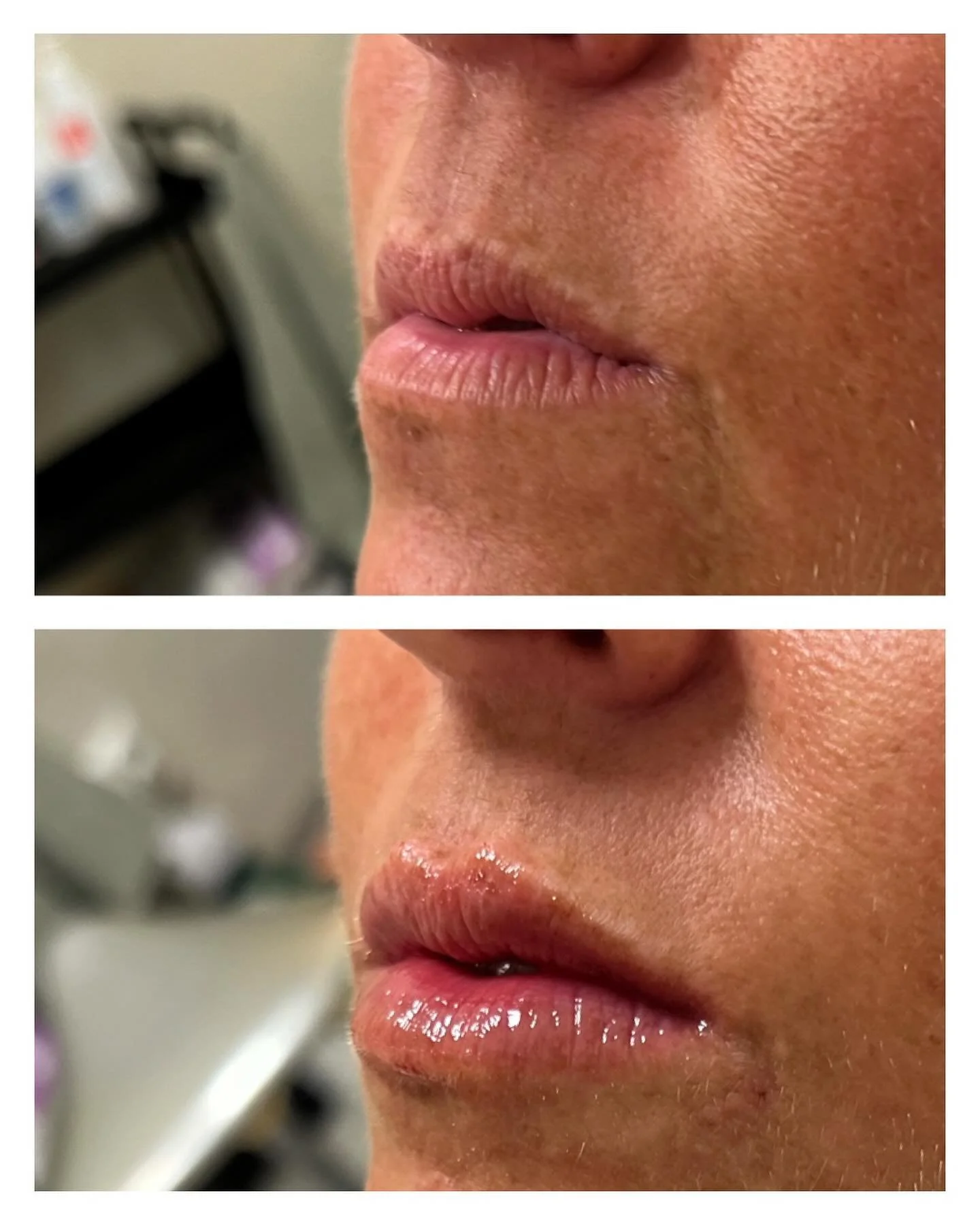 - LÄPPAR -
Ett naturligt resultat med 0.55ml fillers, vi har jobbat med både trubbig kanyl och vass kanyl.