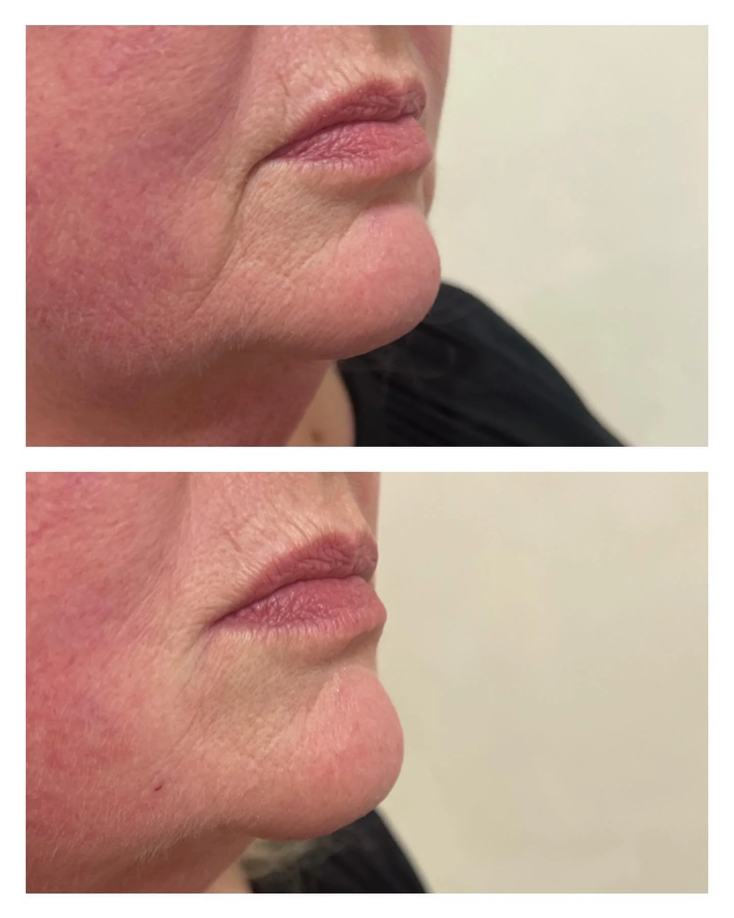 - MARIONETTLINJER - 
Behandling av marionettlinjer med fillers för att återskapa ett gladare utseende. Bilderna är tagna före och direkt efter behandlingen.
#fillers #filler #injektionsbehandlingar #teosyal #fillerskalmar #mari