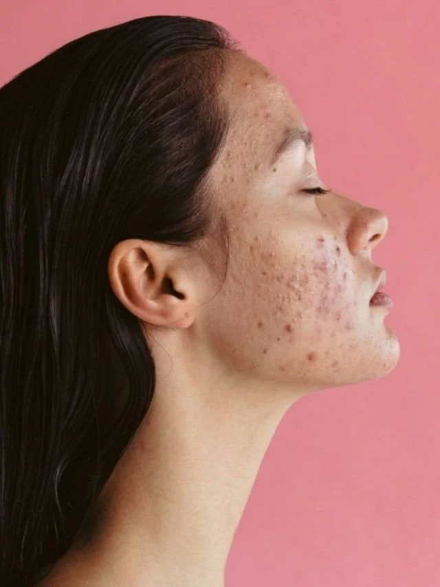 Peau sensible : comprendre, apaiser et renforcer durablement