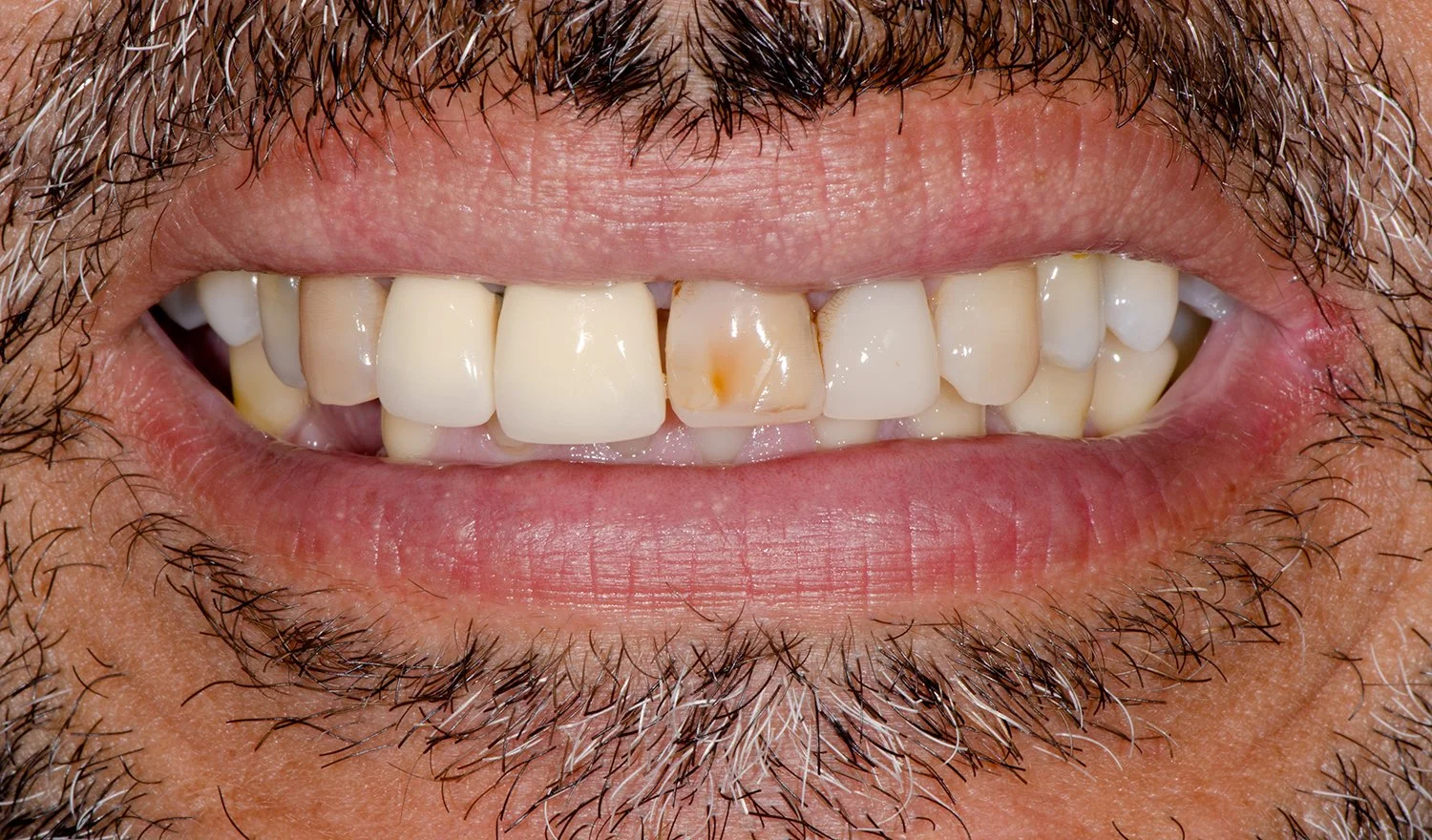 Dental Crowns Before