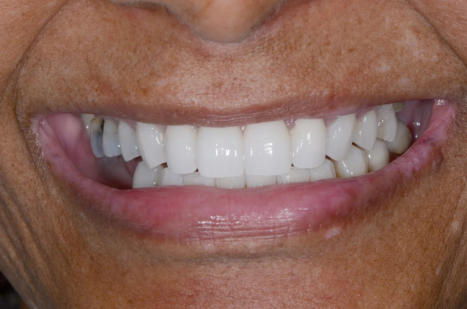 Dental Crowns After (Copy)