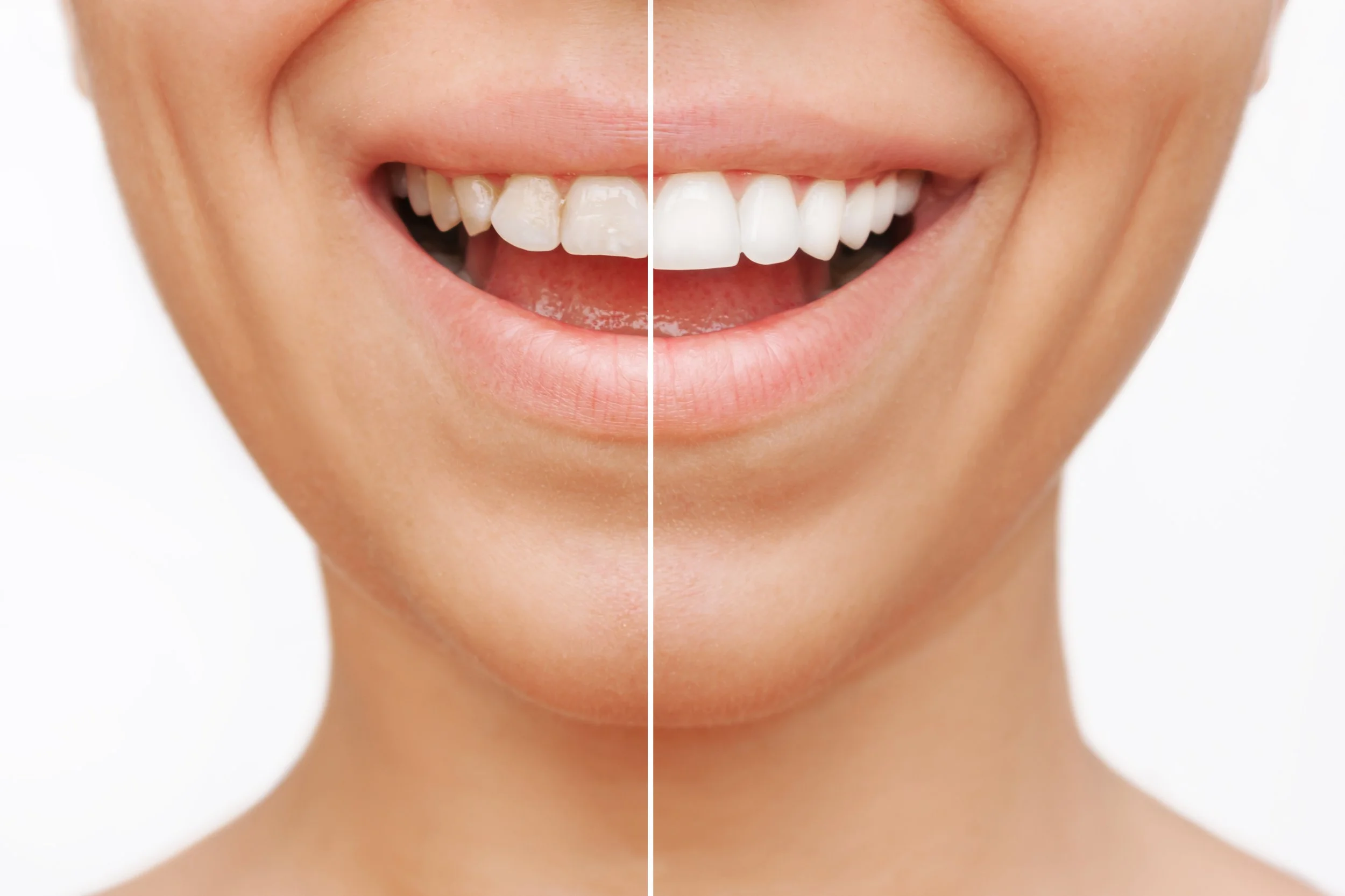 Comparison image of teeth v. veneers. Do veneers stain? Learn how porcelain and composite hold up over time, what causes discoloration, and how to keep your smile bright for years.