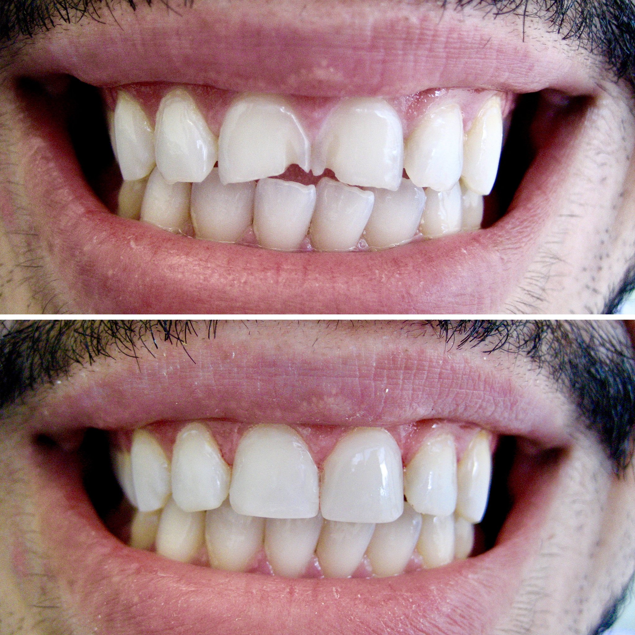 Fixing chipped teeth with Bonding Procedure