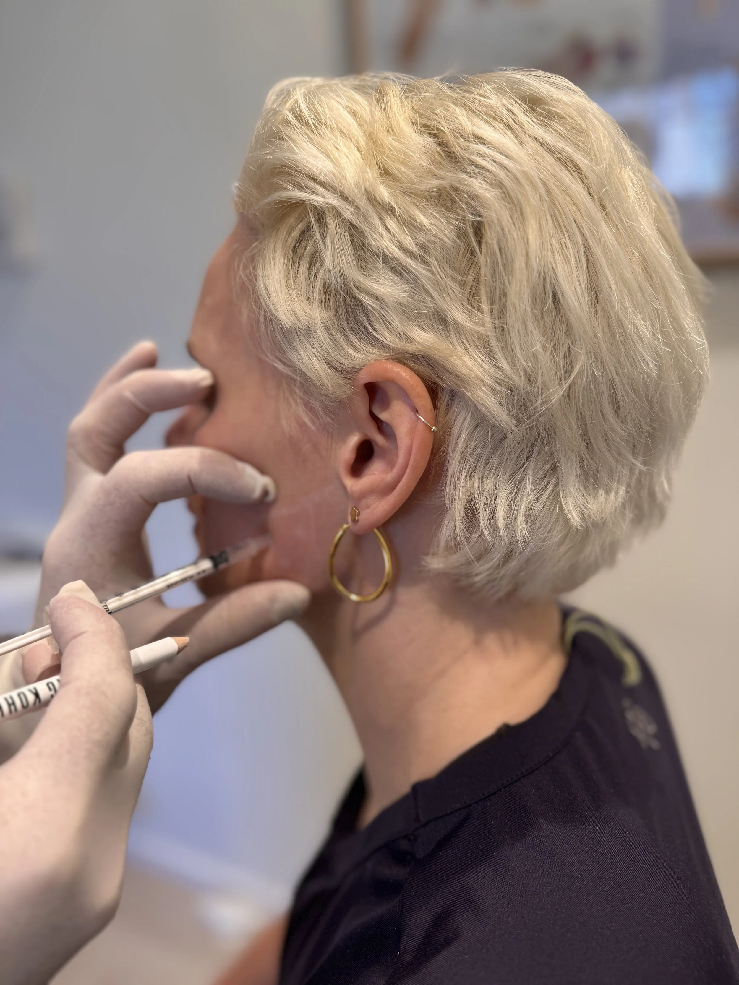 botox kjeve behandling masseter oslo