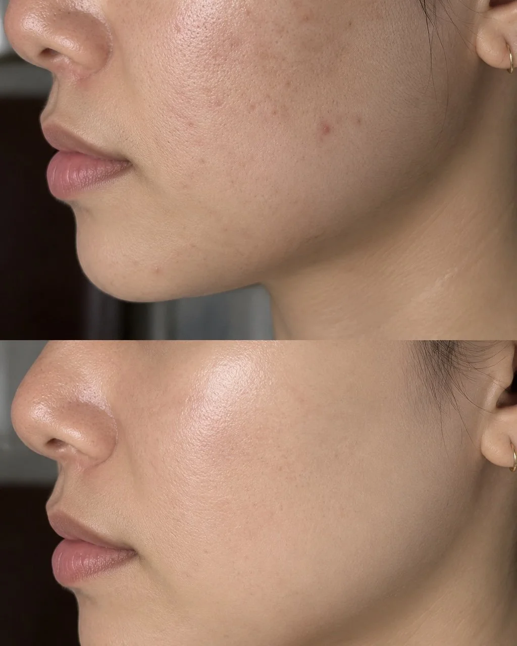 Chemical peel facial treatment for smoother and brighter-looking skin at Thao SD Brow & Lash in San Diego