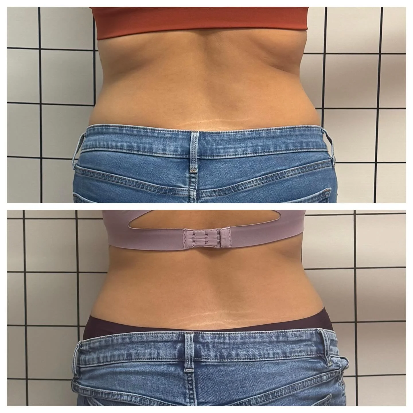 Look at these Incredible results after body sculpting , a tighter waist and smoother back contour. 💫 
Book your 1st appointment today !!! 

#kyletx #budatx #atx #bestprices #bodycontouring #cryo #ilume #NonInvasiveResults