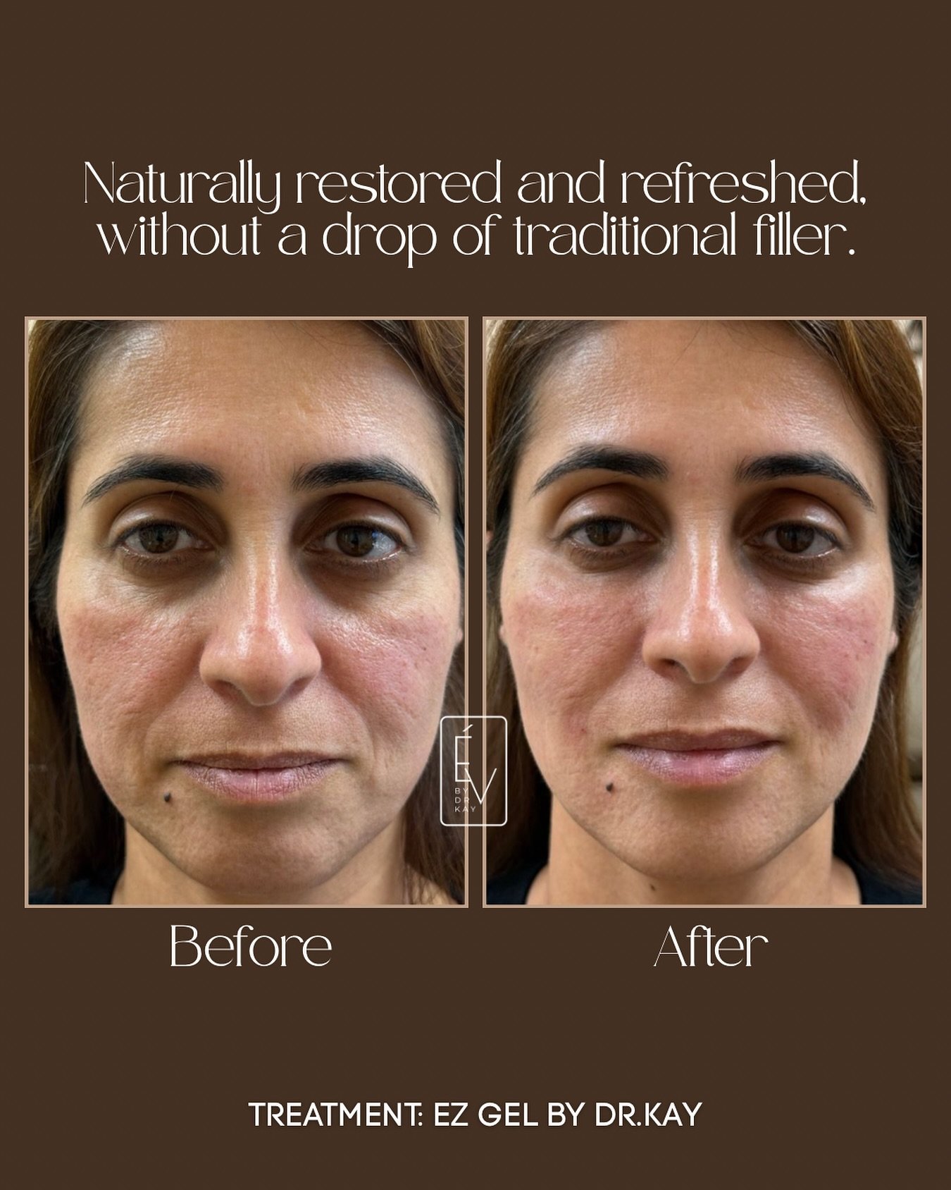 Results so good, they deserve to be framed 🤎✨

This transformation earned a permanent spot on the feed.

Here&rsquo;s what we did: EZ Gel, a natural filler alternative made completely from your own plasma. We treated the under eyes to correct dark c