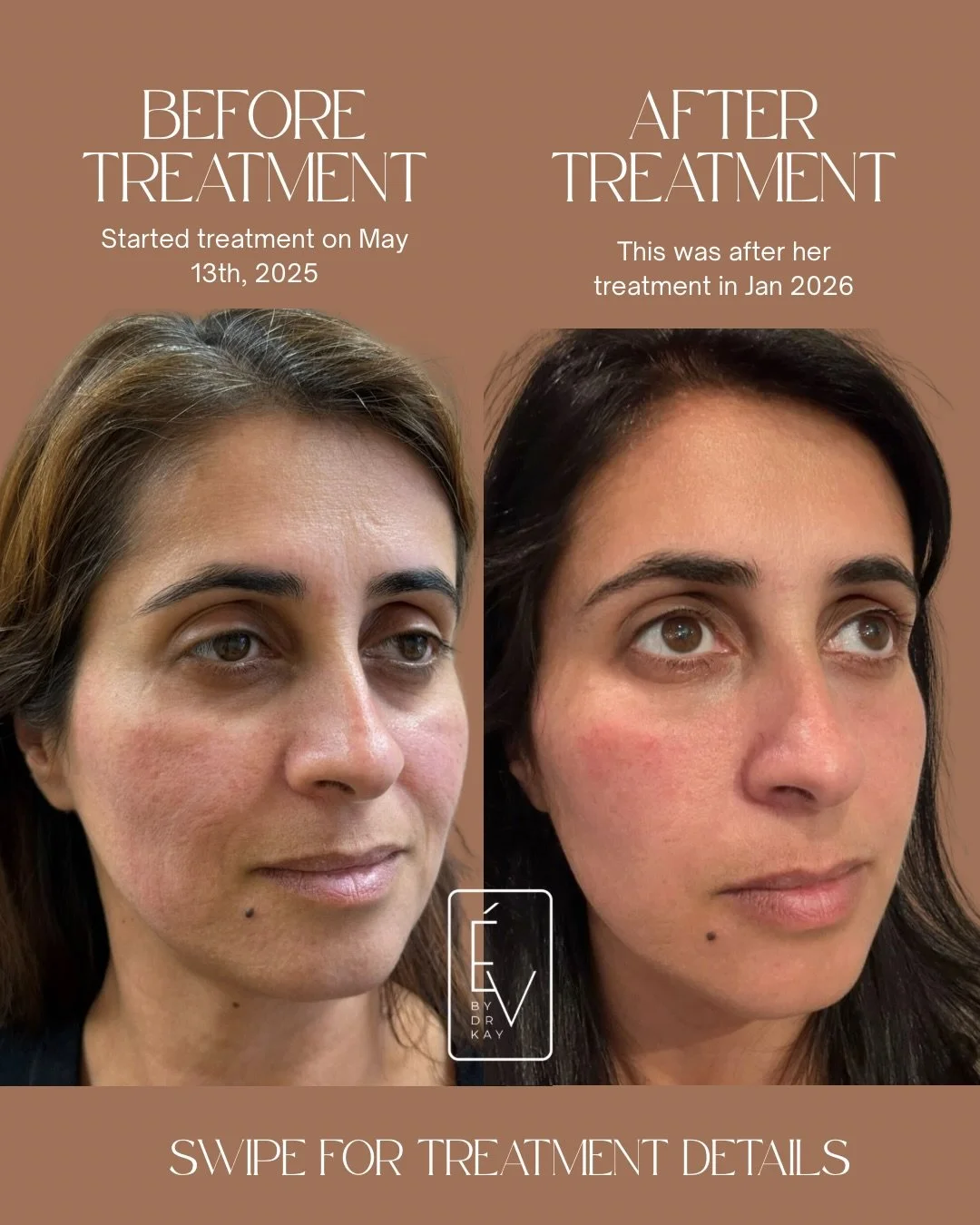 When you combine neuromodulation with regenerative medicine, you get results that look like ✨ this ✨

Nine months of intentional, layered treatment built around one patient&rsquo;s skin, her anatomy, and her goals.

Full face Daxxify to relax and sof