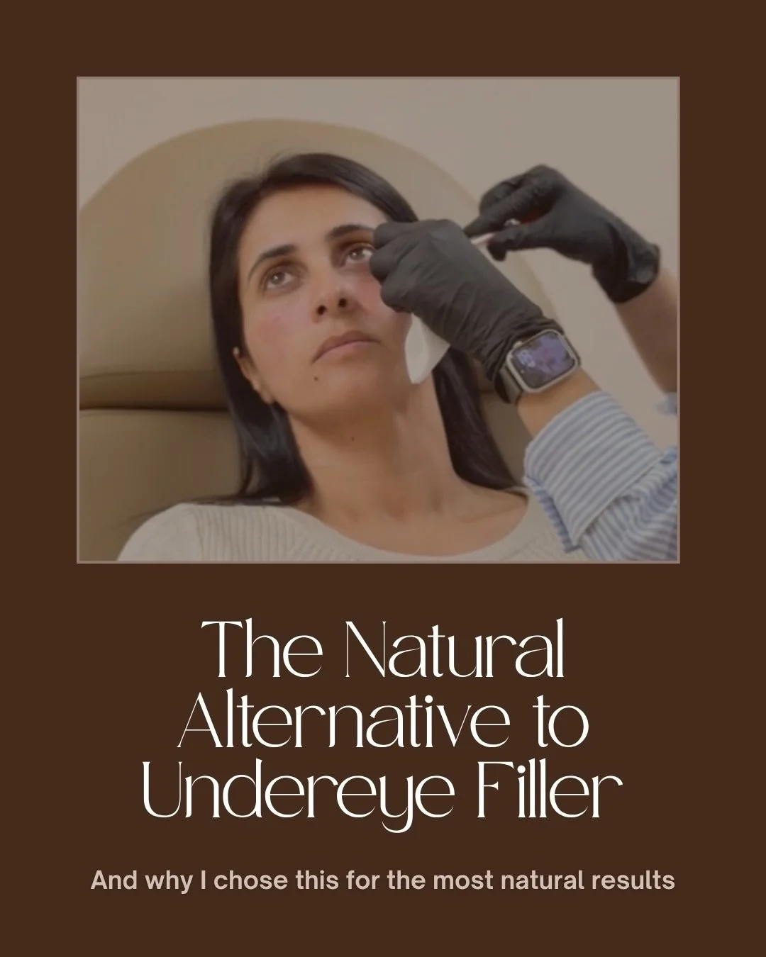 Undereye hollowing and dark circles are one of the top concerns my South Asian patients bring to me. 

Traditional filler can be an option, but for most it&rsquo;s not the right fit. PRF EZ Gel restores volume and hydration under the eyes using only 