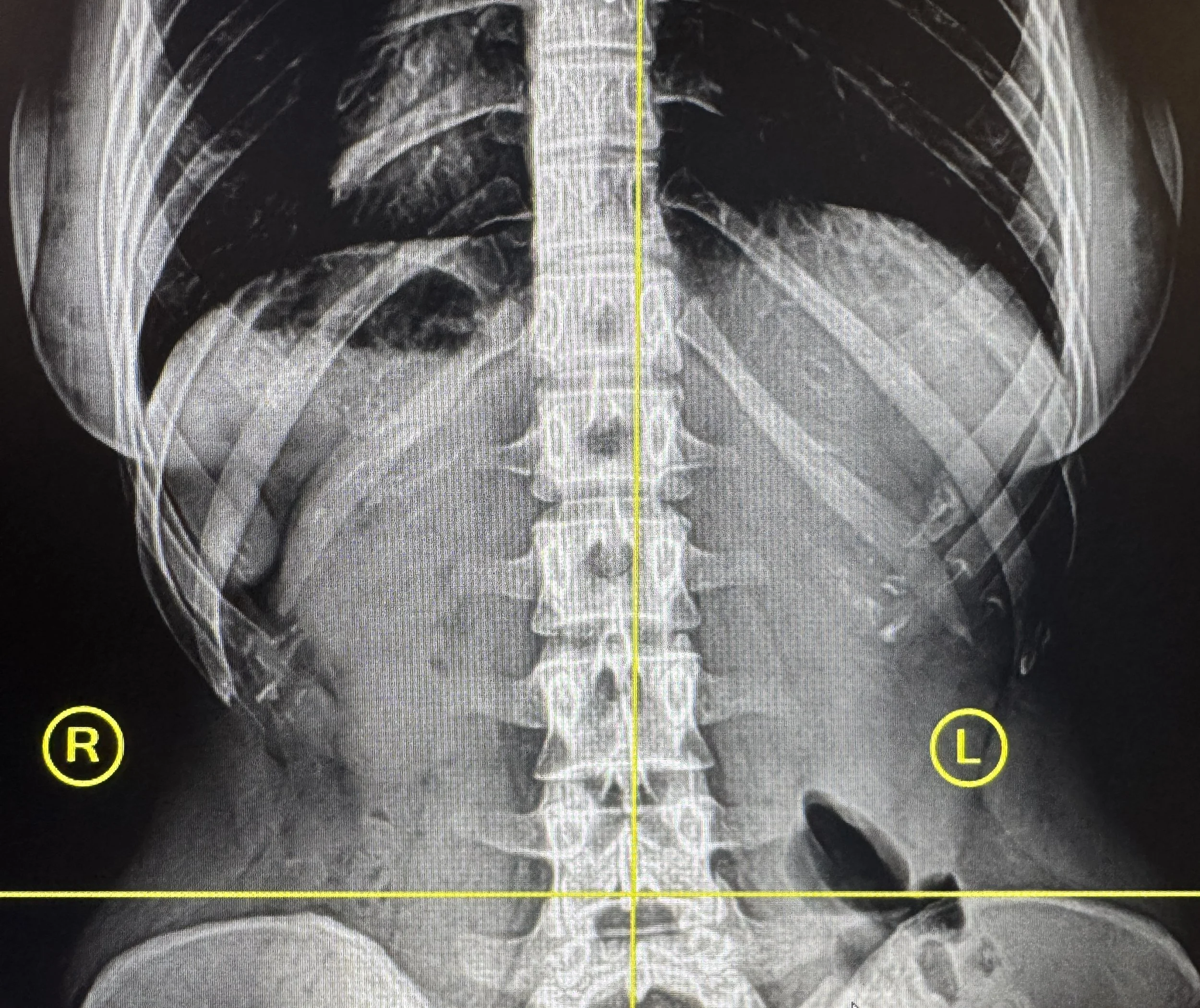 A black and white chest X-ray showing the lungs, ribs, spine, and heart area. The image includes labeled markers for the right and left sides, with the right side labeled 'R' and the left side labeled 'L.'
