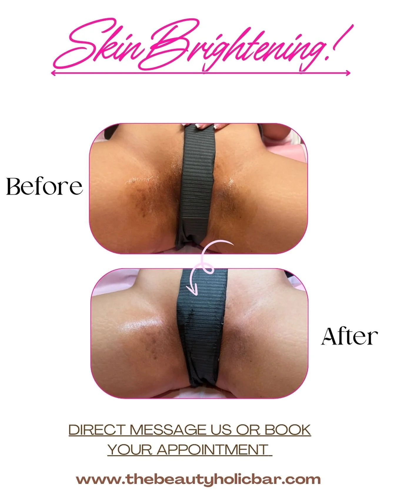 New Service Alert! 🔔- Skin Bleaching/Brightening🫶🏻😍❤️&zwj;🔥❤️&zwj;🔥❤️&zwj;🔥