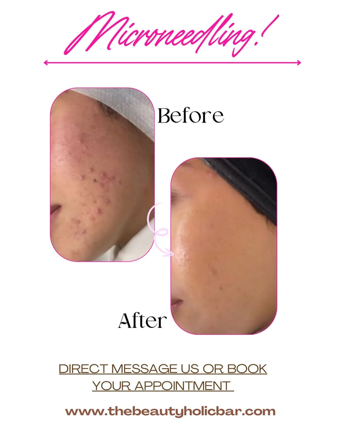 Don&rsquo;t wait any longer for your deserved happiness! #micromeedling