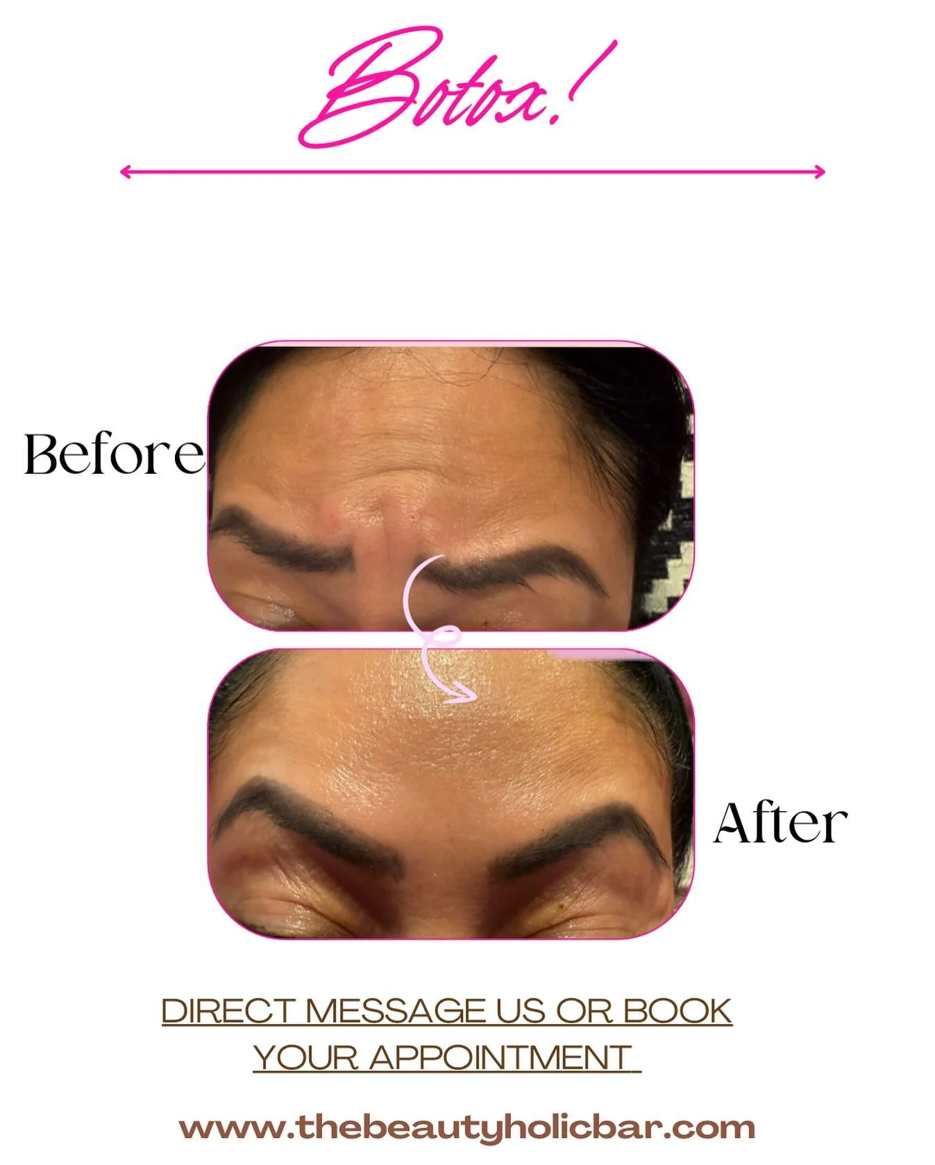 Yasss! Botox baby! 😍✨💕