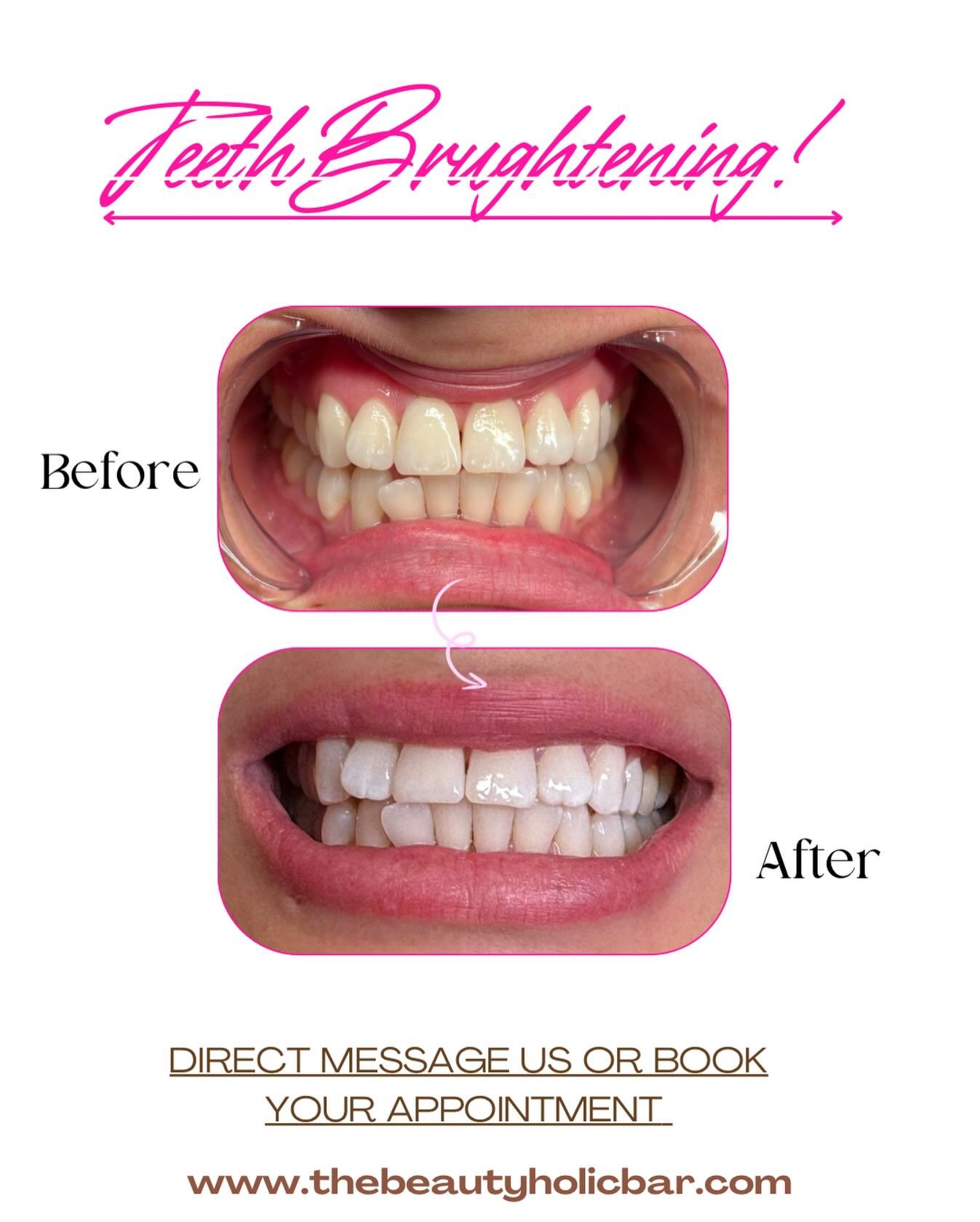 Get your pearly whites for the holidays 🦷✨🥰🤍