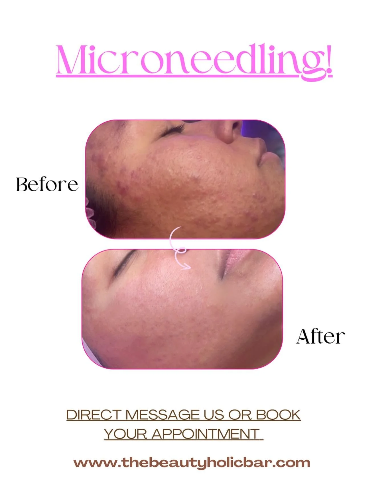 New Year, New YOU🫂❤️! #microneedling