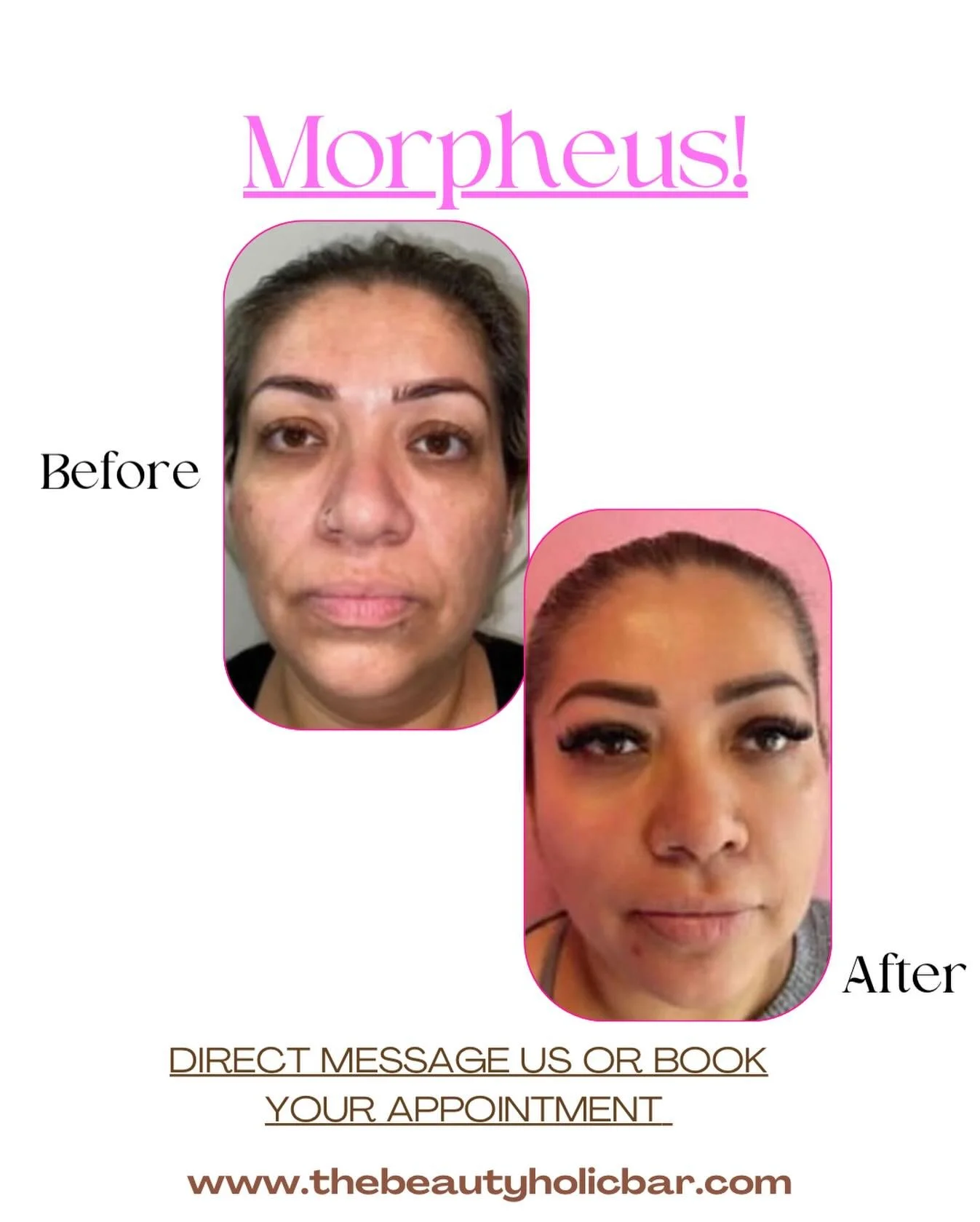 Zulma thanks so much for trusting us in your skin ✨journey 🫶🏻🥹😍 your skin is flawless! ❤️&zwj;🔥❤️&zwj;🔥❤️&zwj;🔥