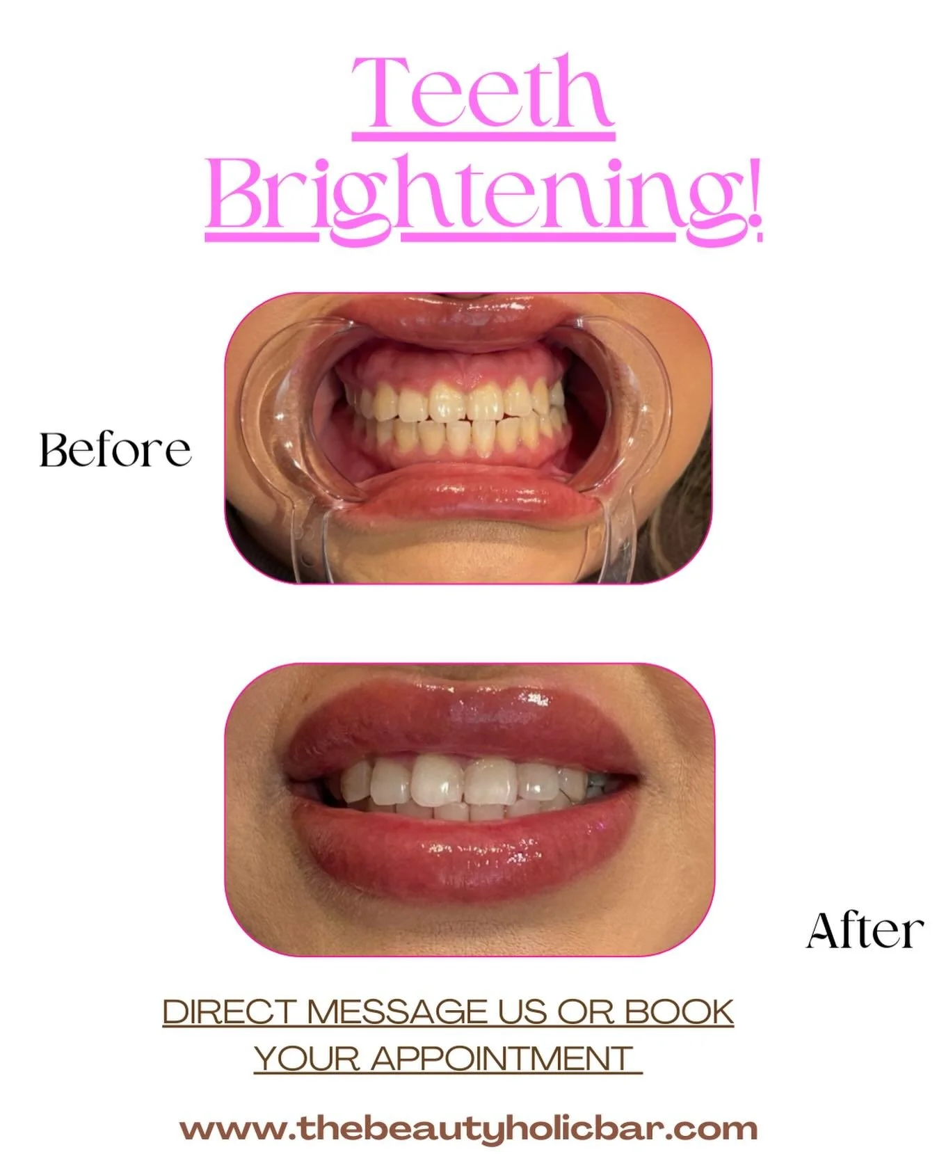 Our girl is starting off the year right with her pearly whites 🦷 ✨✨✨✨ book your white teeth for a  1 hour session only $99! 😍💞💞💞💞