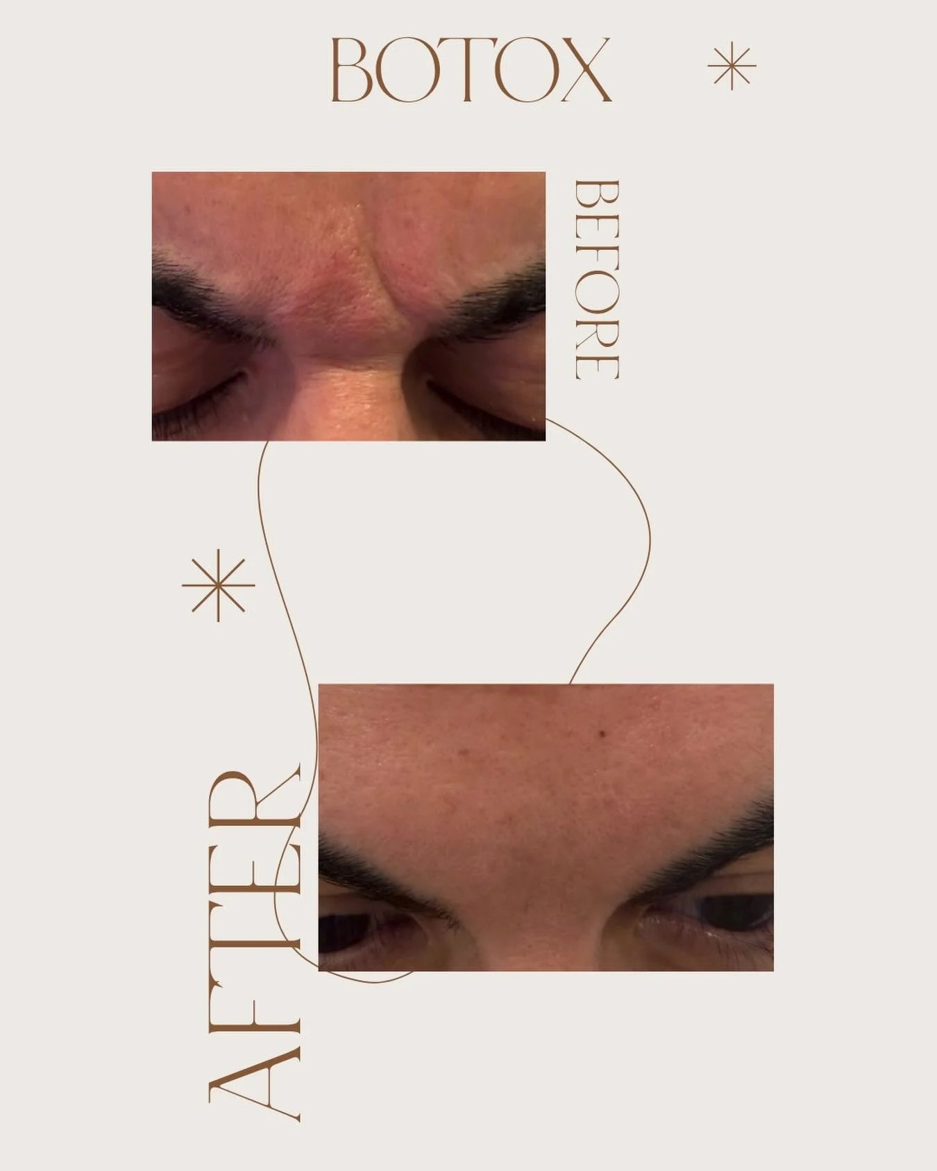 No more frown lines😍✨✨✨✨ Book your Botox 🤗💕💕💕💕💕💕#botox #botoxeastla #botoxface