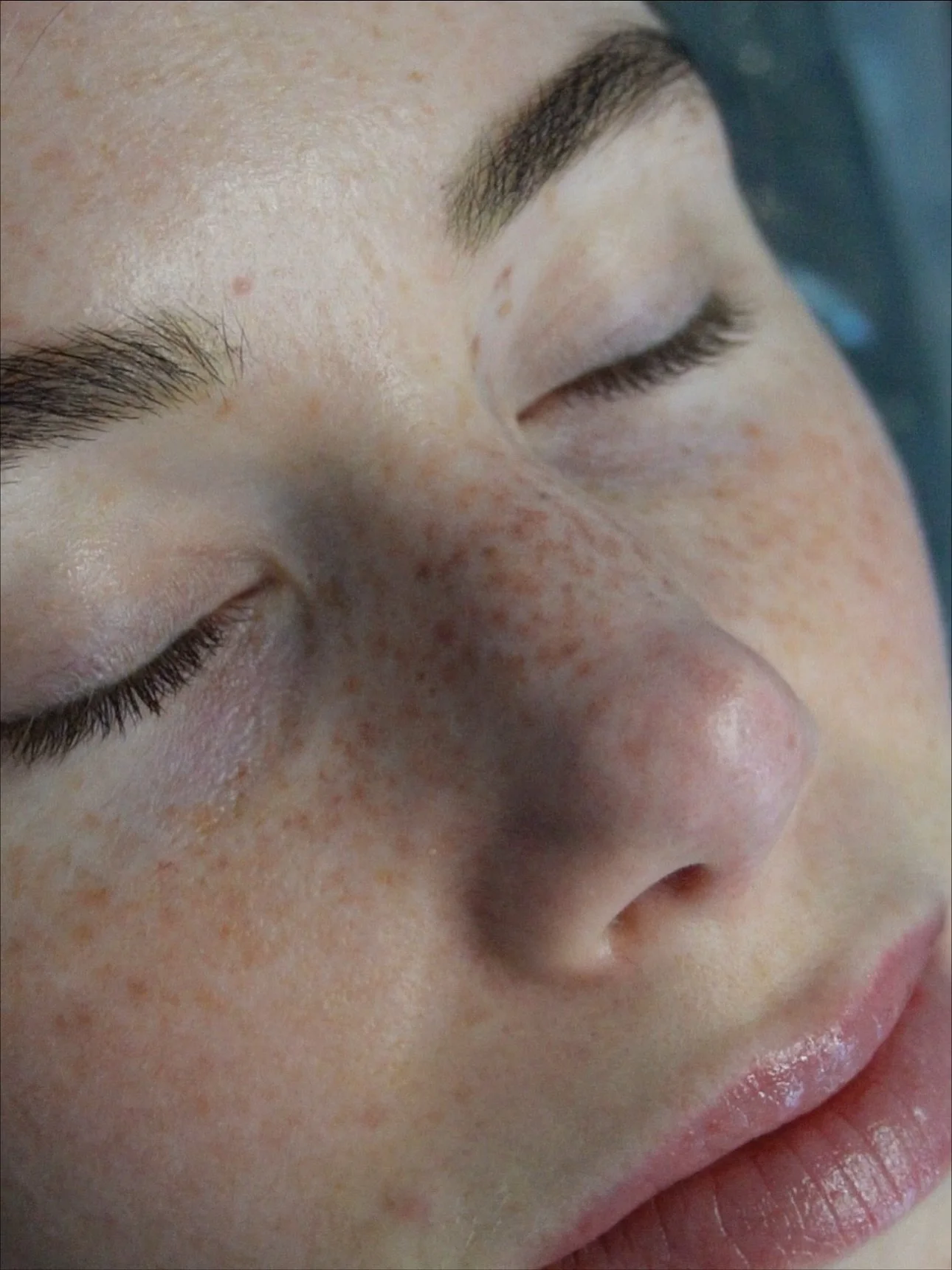 Healed Freckle Tattoo 🪄 (1.5 year fade out)

Coverage: Med/Heavy 

📆
Fully Booked through December 
January appointments open 12/1 at 12pm pst on a first come first reserved basis 

👩&zwj;🏫
Freckle Flow 2.0 (online) enrollment is open and availab