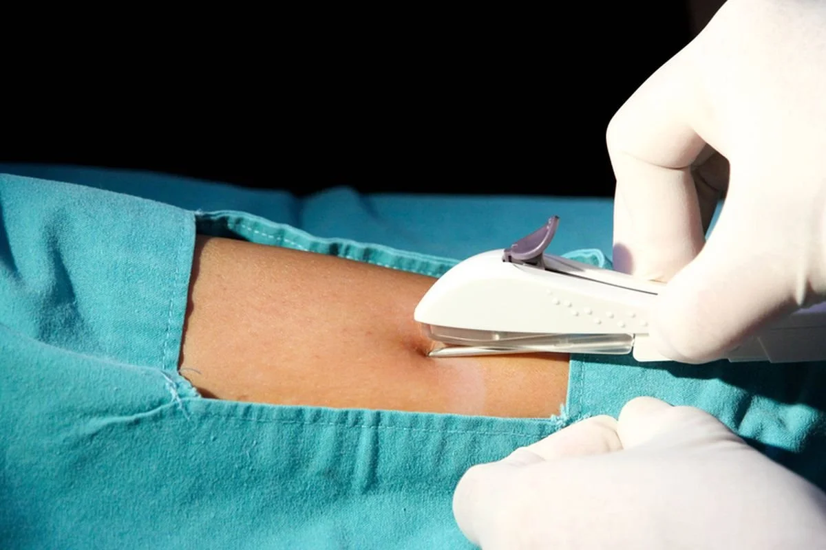 Pemasangan &amp; Pelepasan Kontrasepsi Implan di Filmore Medical