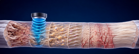 Shock Wave Therapy