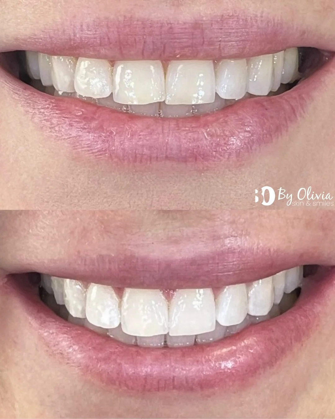 This is a friendly reminder that our Summer Teeth Whitening Promo at Wanaka Dental ends this month! 🌟

✨ InChair whitening is now just $360 (was $410).
✨ Whitening combo for $500 (was $600) - includes gel and custom whitening trays.

There&rsquo;s s