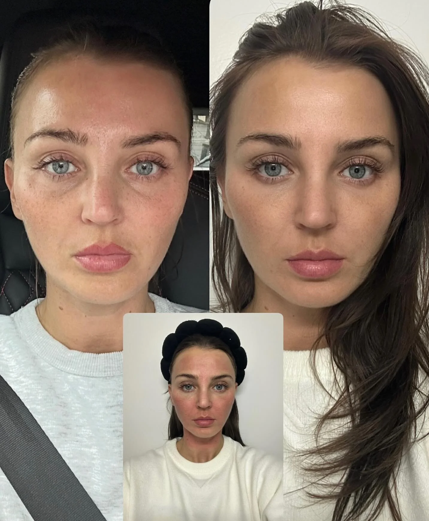 Nur 9 Wochen Unterschied 

2x Microneedling (abstand 3 Wochen)
3x Bio-Remodeling (1x pro Woche) 

Microneedeling: Mikroverletzungen regen den nat&uuml;rlichen Heilungsprozess an, stimulieren Fibroblasten und f&ouml;rdern die Neubildung von Kollagen u